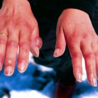 Dita delle mani con geloni evidenti.