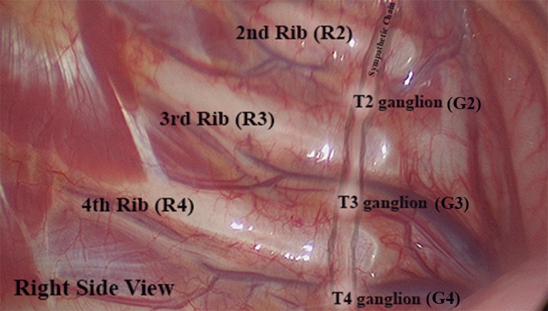 Iperidrosi - Anatomia della catena simpatica sul lato destro - Journal of Toracic Disease